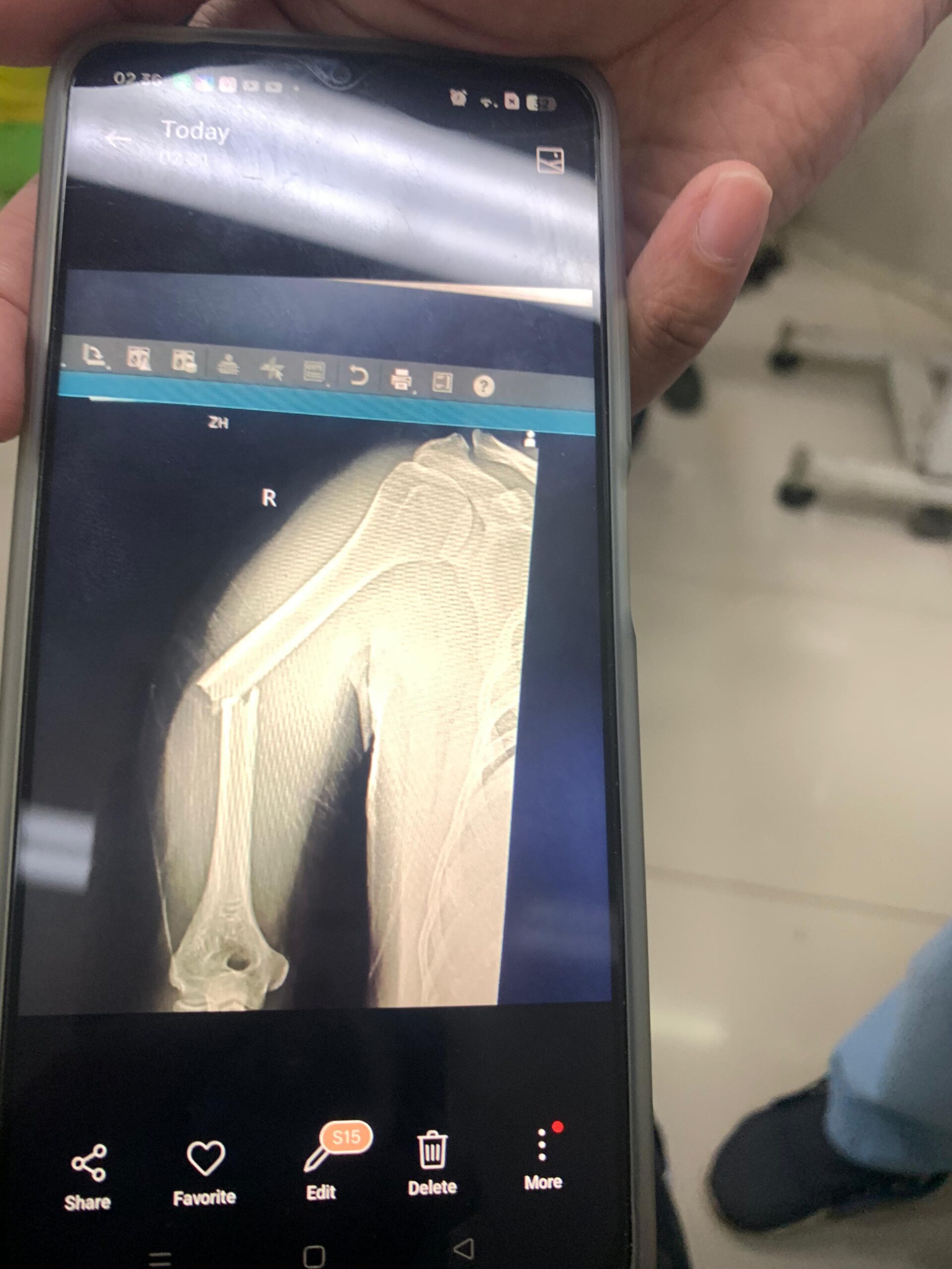 KONDISI KORBAN AF SEEBELUM OPERASI DI RSUD - KECELAKAAN MELIBATKAN MOBIL APV DAN DUA MOTOR TERJADI DI LEUWILIANG, BOGOR BARAT